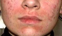 Как бороться с кожной аллергией