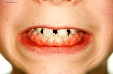 Бруксизм: лечение народными средствами как самый действенный метод борьбы с «зубной» песней