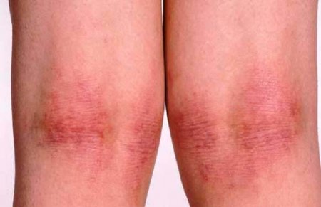Сыпь под коленками: причины и лечение