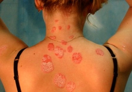 Причины возникновения и лечение сезонной аллергии