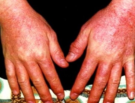 Природные способы лечения аллергии