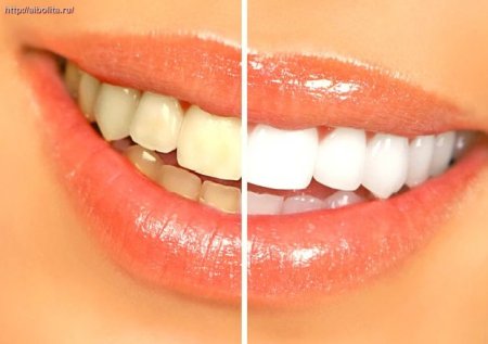 Как отбелить зубы дома – Красота и здоровье
