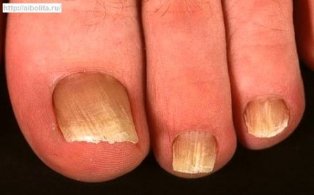 Черно-белые ногти как первые признаки необходимости медицинского обследования