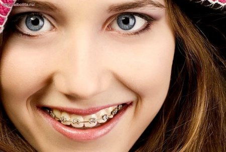 Зубы после ношения брекетов