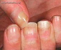 Дистрофия ногтей лечение