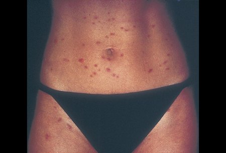 Лечение кожной аллергии