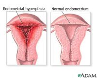 Гиперплазия эндометрия матки