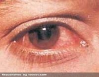Покраснение глазного яблока: причины и лечение