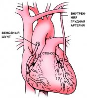 Систолический шум в сердце, его причины и лечение
