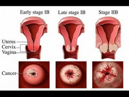 Как происходит нарочное лечение лейкоплакия шейки матки