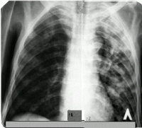 Фазы диссеминированного туберкулеза