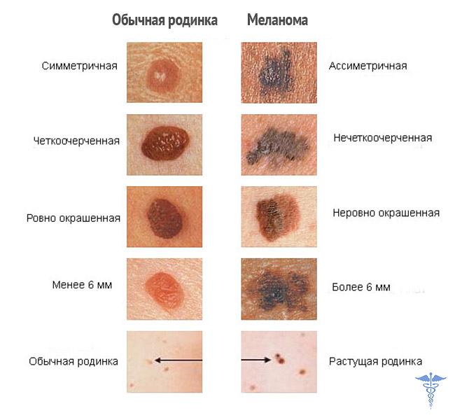 Виды опухолей кожи с фото